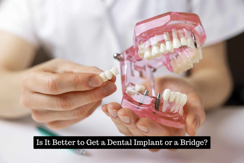 Is It Better to Get a Dental Implant or a Bridge