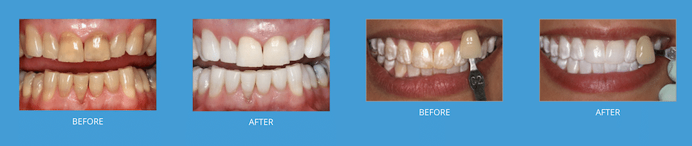 kor teeth whitening knoxville farragut tn