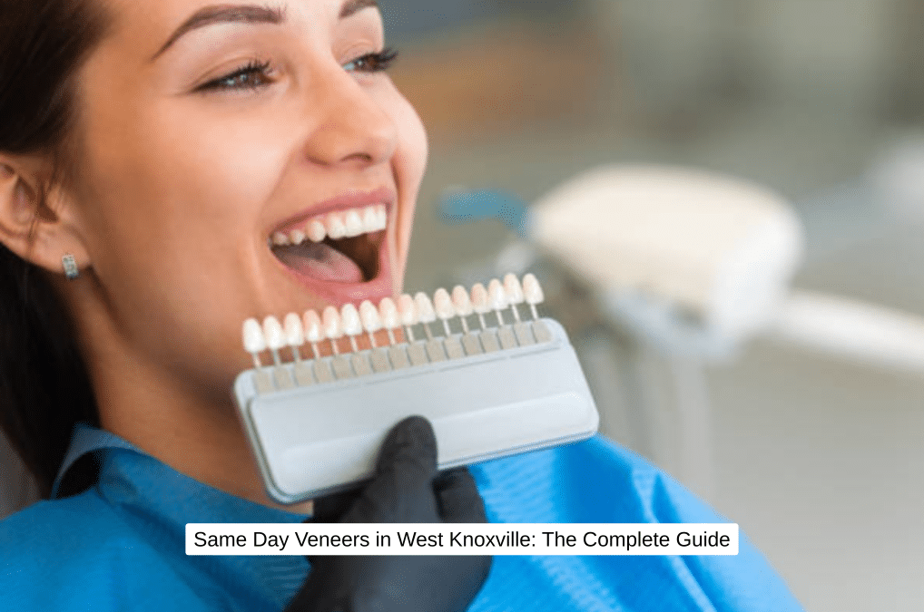 Same Day Veneers in West Knoxville The Complete Guide